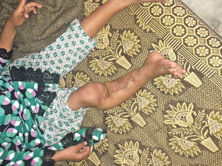 DAMAGE: X-rays show the extent of the injury to Mehreen’s leg