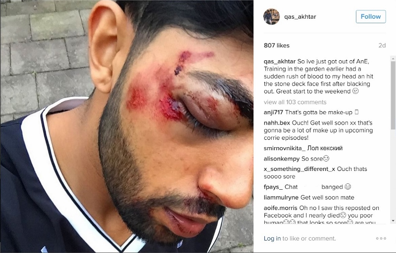 BATTERED AND BRUSIED: Corrie actor Qasim Akhtar had a freak ‘rush of blood to the head’ whilst training in his garden