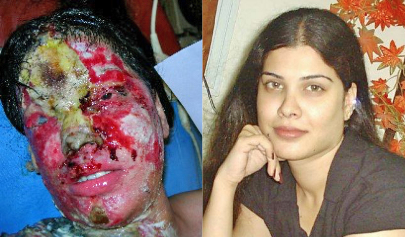 HORRIFYING ORDEAL: Kanwal Qayyum’s face was melted off after her jealous friend doused her with sulphuric acid