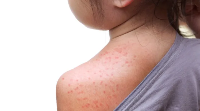 As measles cases rise, national incident declared