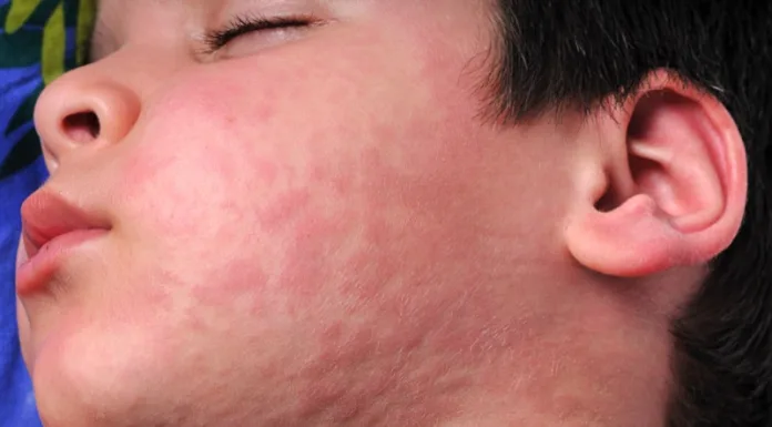 Measles is more than just a rash
